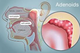 Adenoiditis